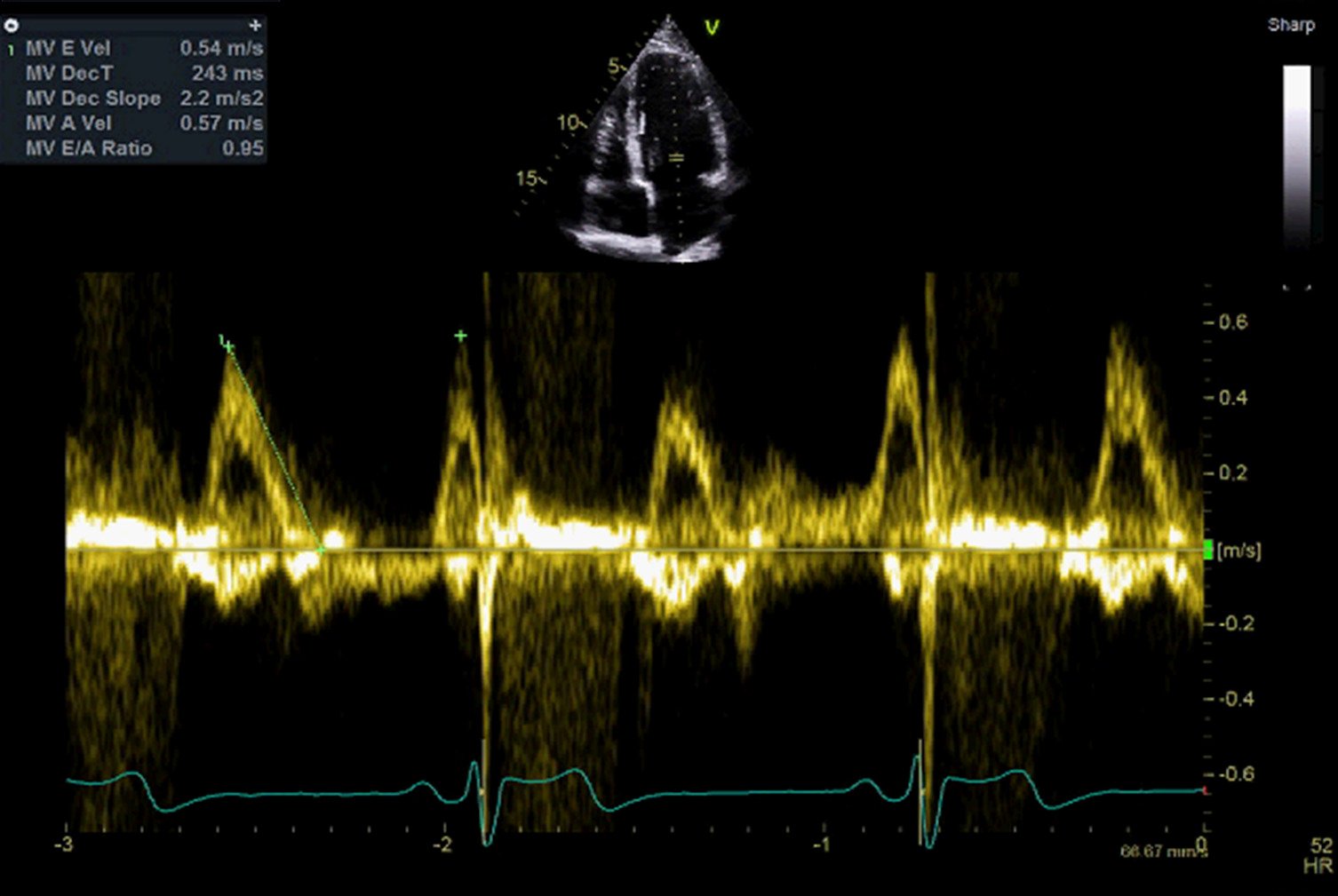heart scan showing diastolic function