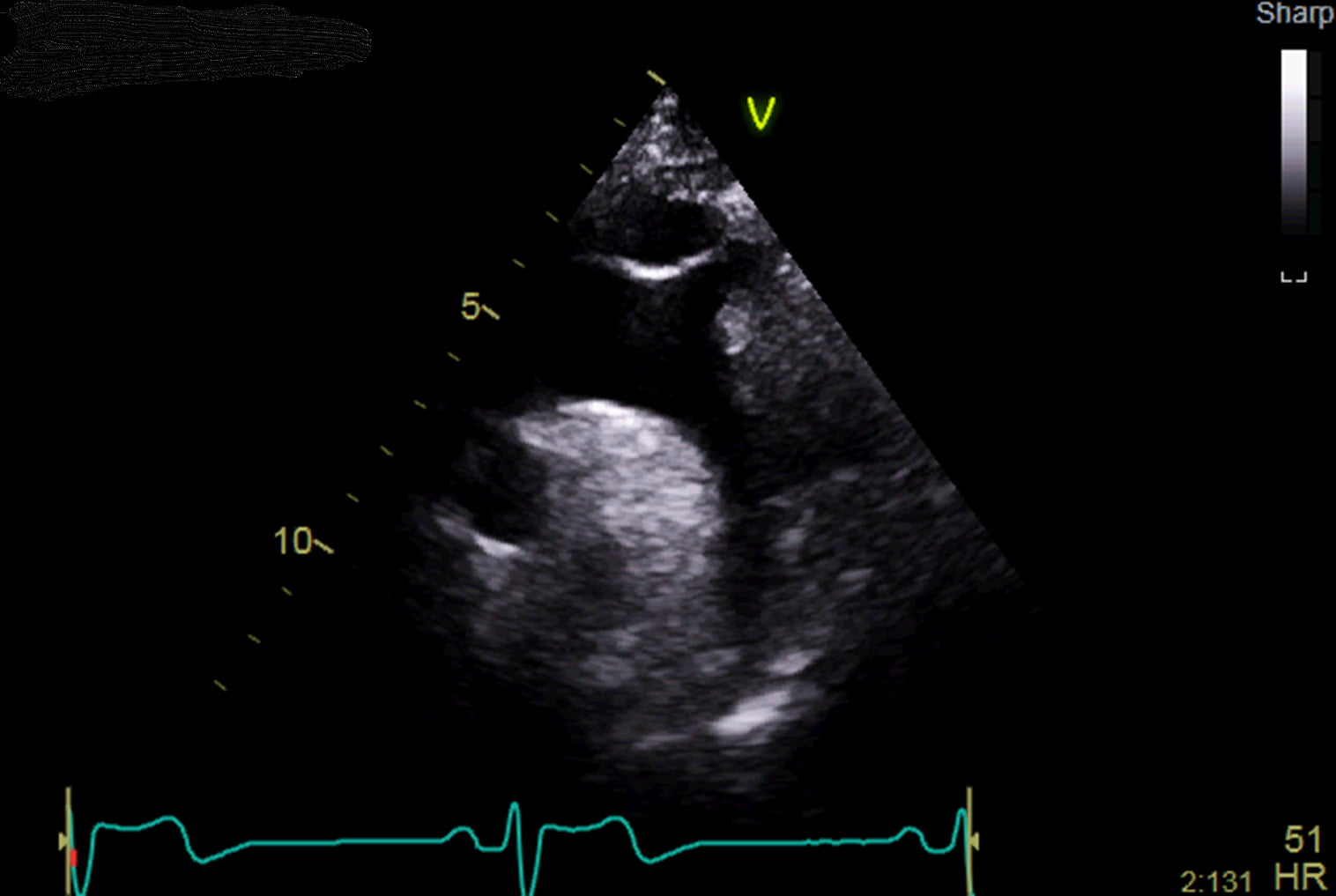 echocardiogram showing the aorta in the heart