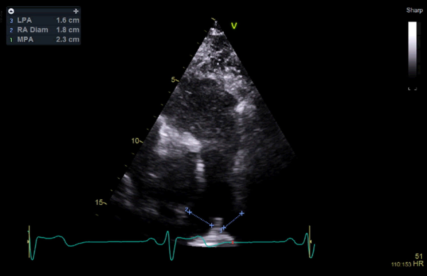 echocardiogram showing the pulmonary artery of the heart