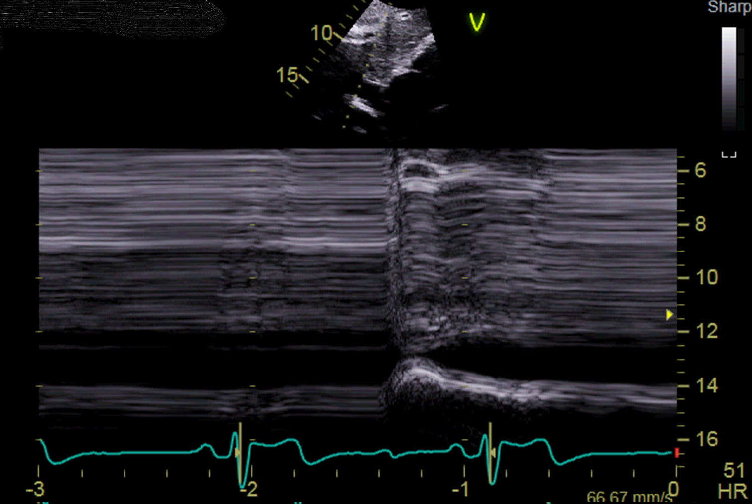 echocardiogram showing the inferior vena cava of the heart