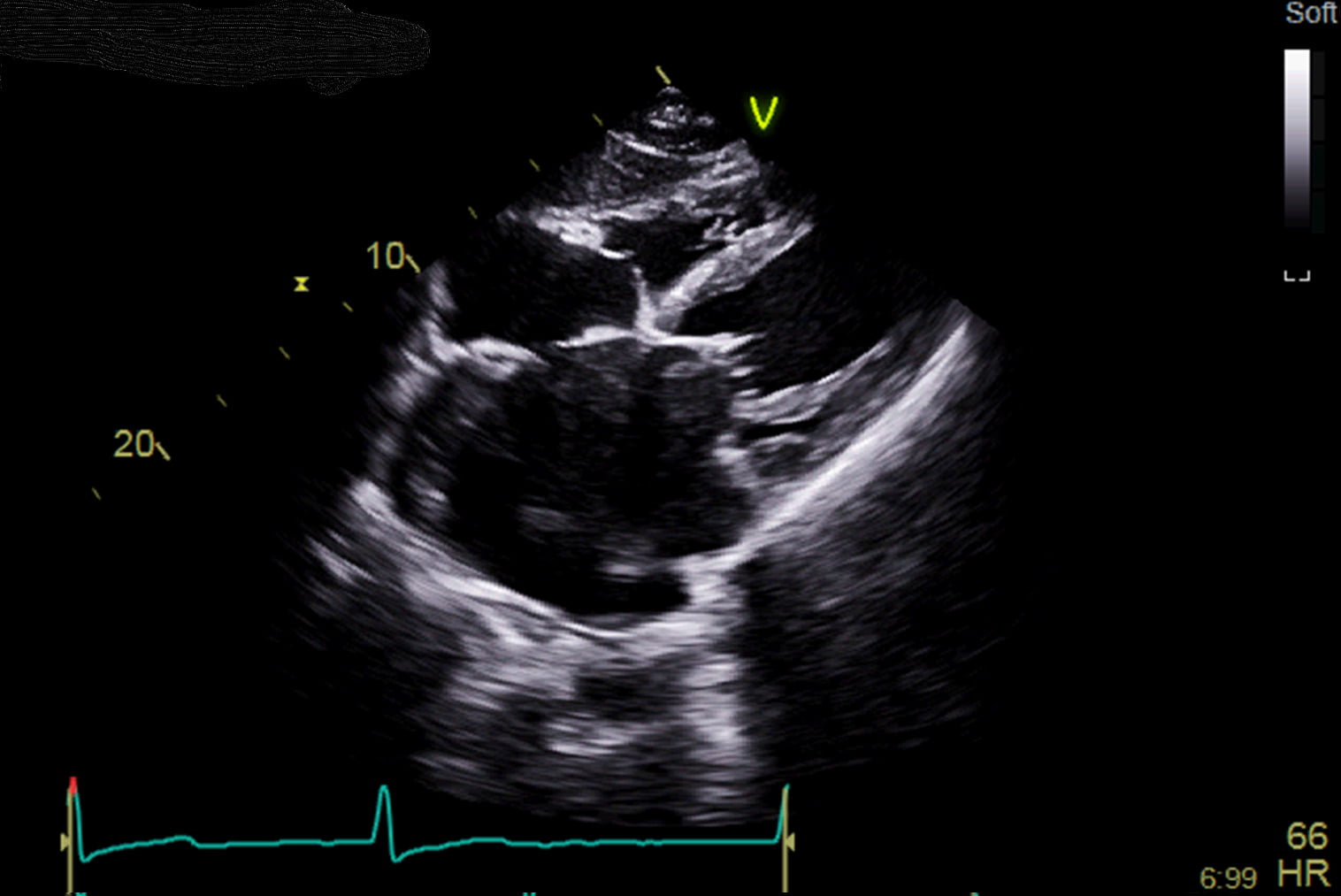 echocardiogram showing the pericardium of the heart
