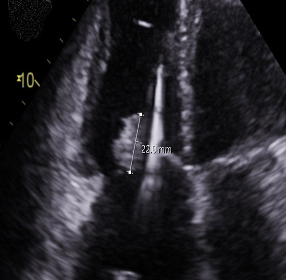 echocardiogram showing mass on heart valve