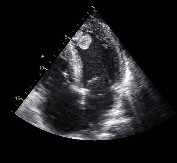 echocardiogram showing a mass on the thrombus