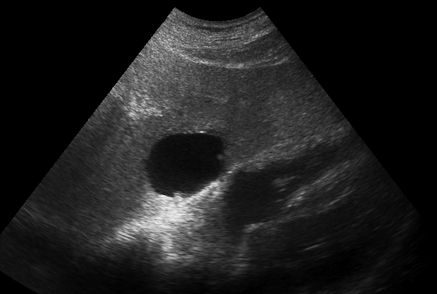 Echocardiogram showing mass on the heart