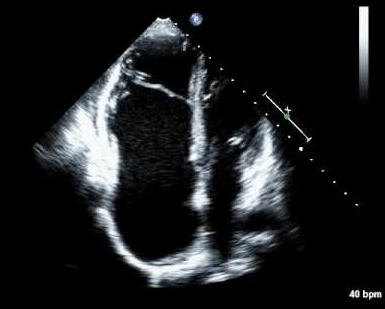 Echocardiogram of a heart