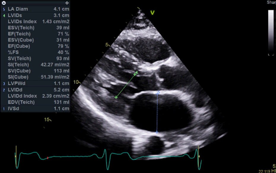 Echocardiogram showing heart chamber size