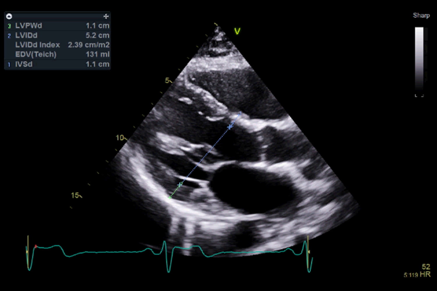 heart scan showing wall thickness