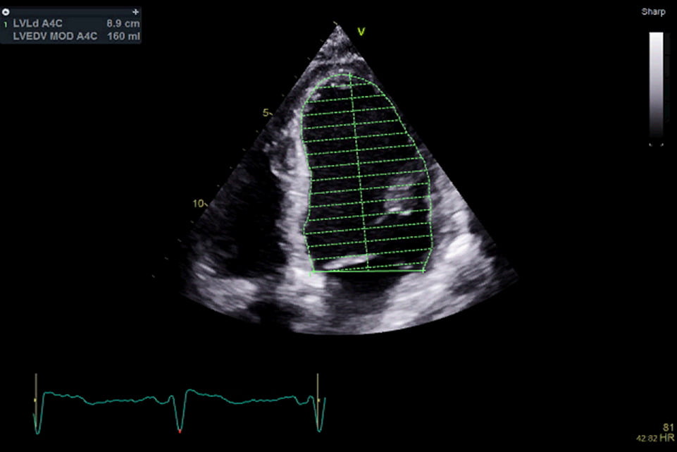 echocardiogram showing systolic function