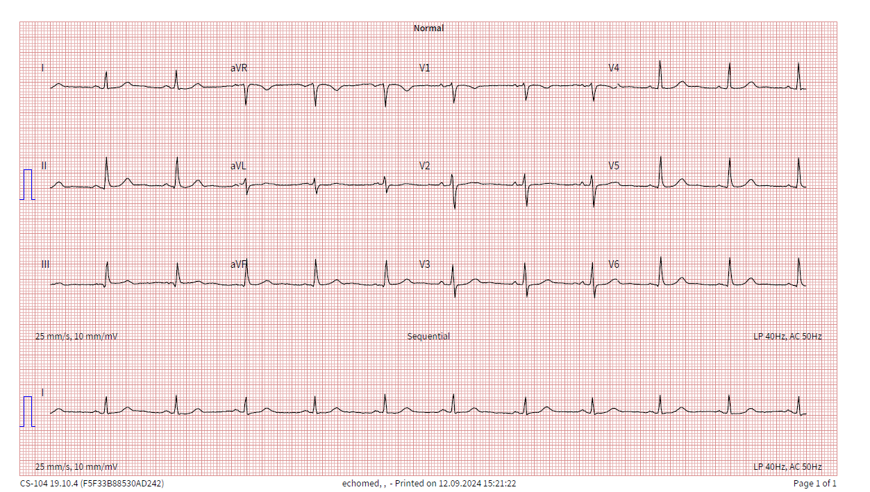 An echocardiogram results graph sheet.
